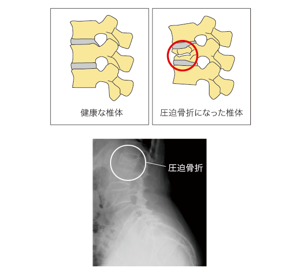 骨粗鬆症/圧迫骨折