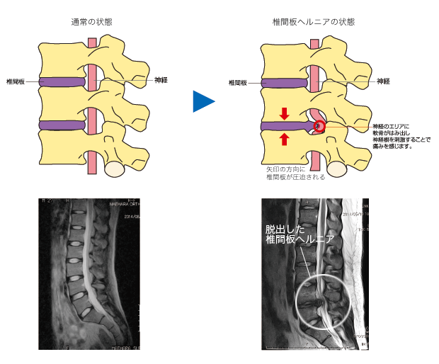 腰椎椎間板ヘルニア ｜大府市 整形外科｜前原整形外科リハビリテーションクリニック