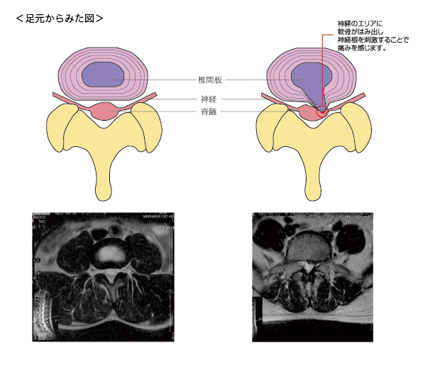 腰椎椎間板ヘルニア