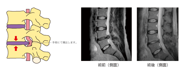 腰椎椎間板ヘルニア