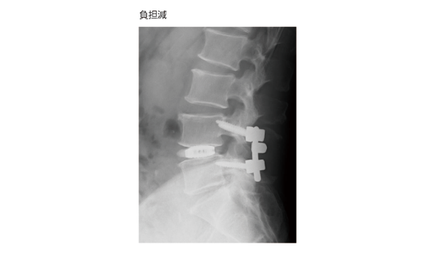 腰椎椎間板ヘルニア