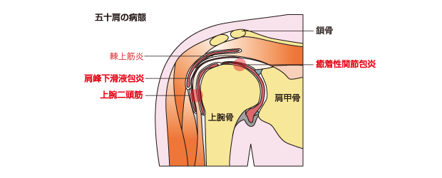 五十肩(肩関節周囲炎)