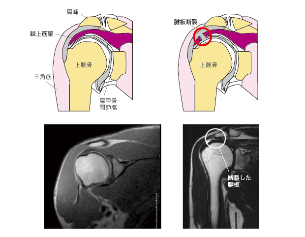 肩腱板損傷