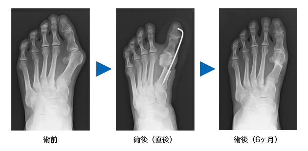 外反母趾