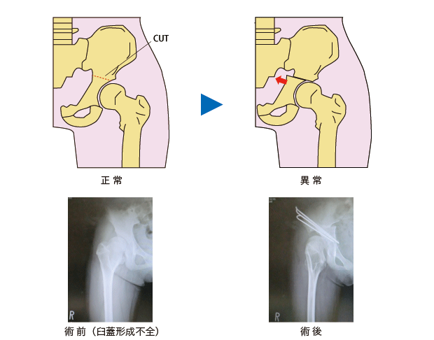 臼蓋形成不全症