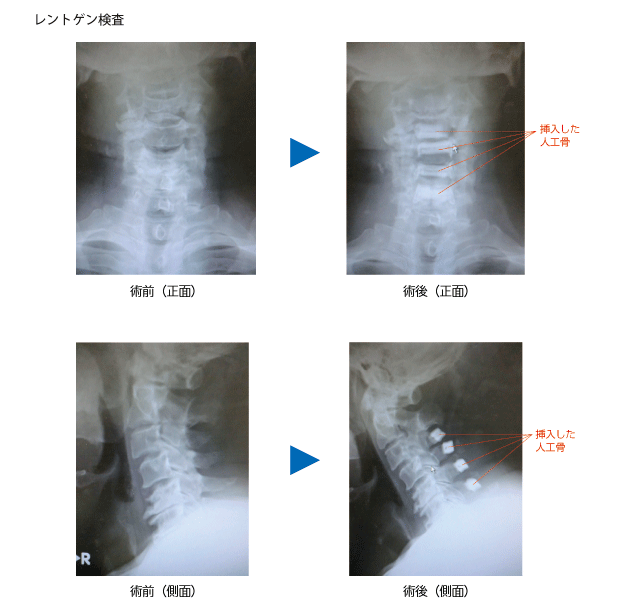 頸部脊椎管狭窄症