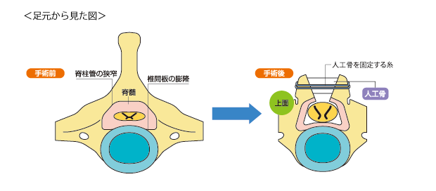 頸部脊椎管狭窄症