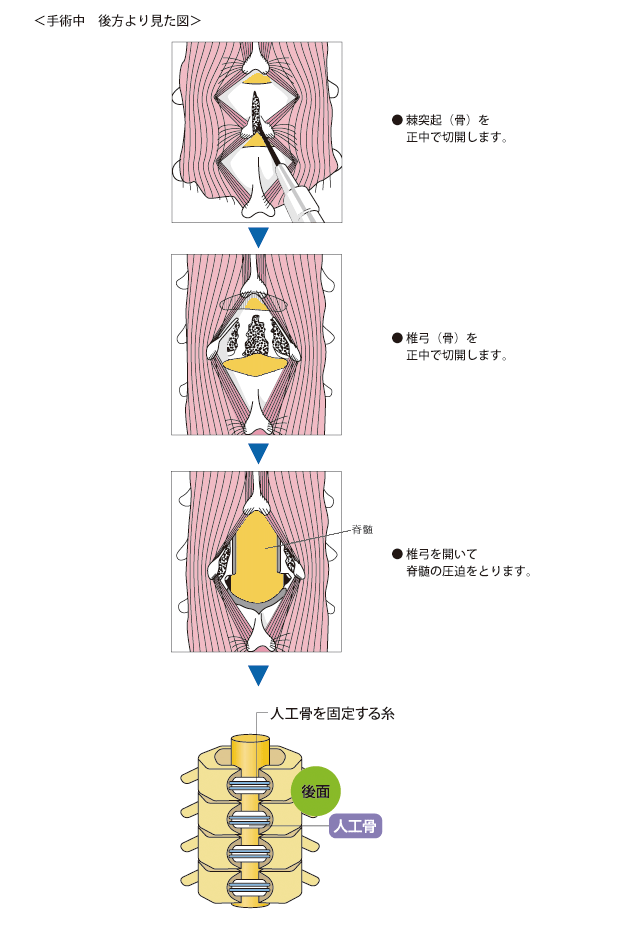頸部脊椎管狭窄症