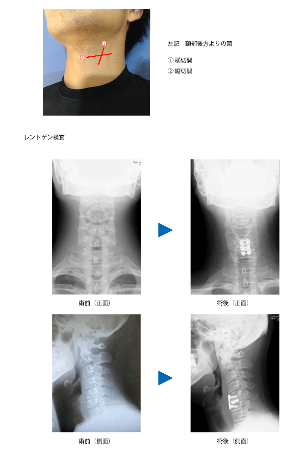 頸椎ヘルニア