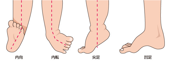 先天性内反尖足