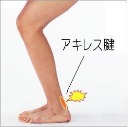 炎 治療 アキレス腱