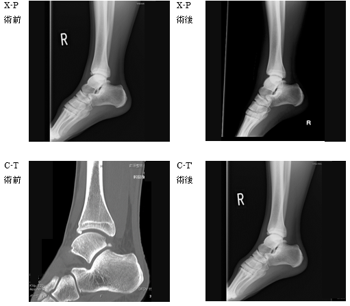 Footballer’s ankle