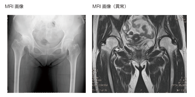 股関節唇損傷
