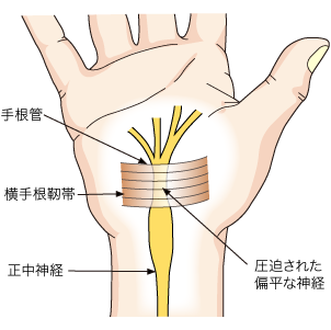 手根管症候群