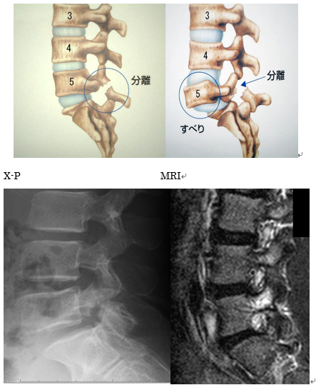 >腰椎分離症・すべり症