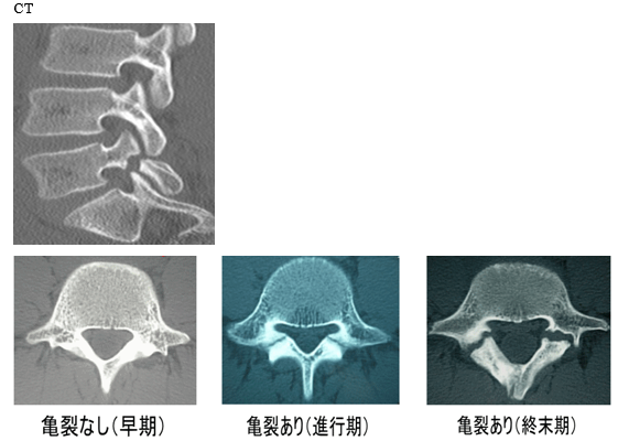 >腰椎分離症・すべり症