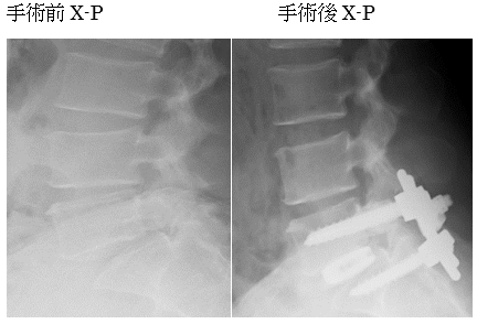 >腰椎分離症・すべり症