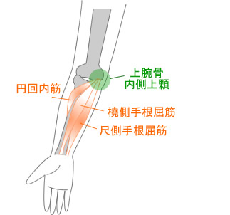 >上腕骨内側上顆炎