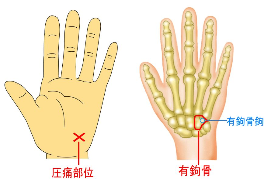 >有鉤骨鉤突起骨折