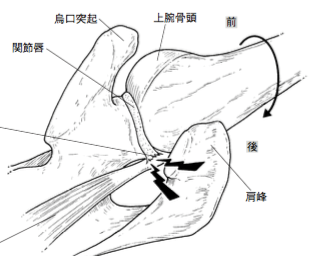 >肩インピンジメント症候群