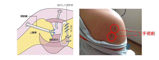 >肩関節脱臼