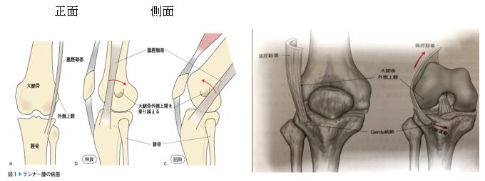 >腸脛靭帯炎
